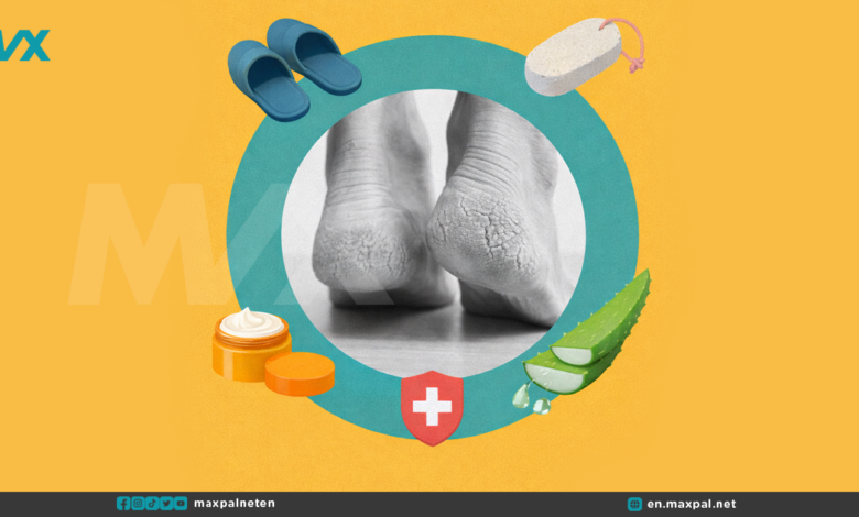 Cracked Heels Home Remedies: Gentle Ways to Soothe Dry, Painful Feet