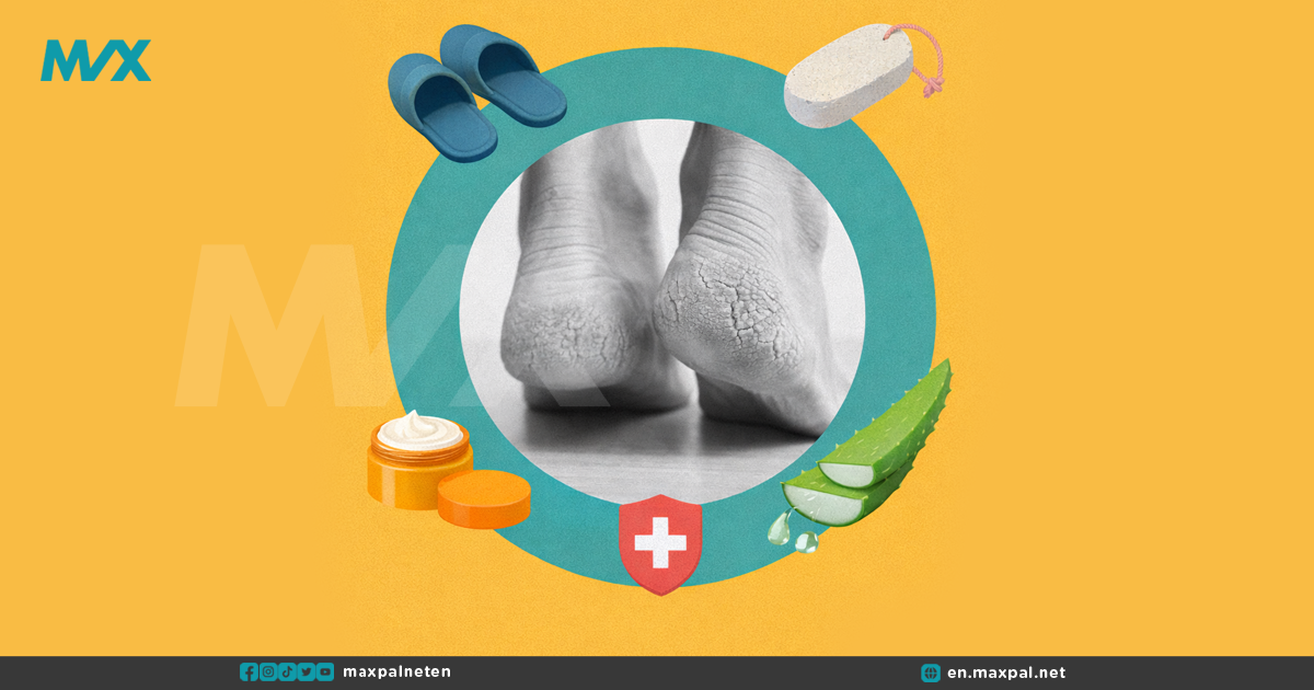 Cracked Heels Home Remedies: Gentle Ways to Soothe Dry, Painful Feet