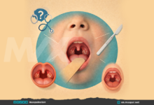 Tonsillectomy in Children: When Surgery Is Needed?