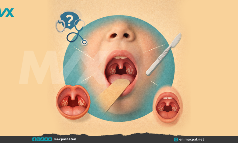 Tonsillectomy in Children: When Surgery Is Needed?