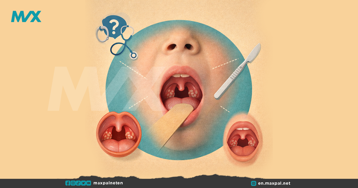 Tonsillectomy in Children: When Surgery Is Needed?